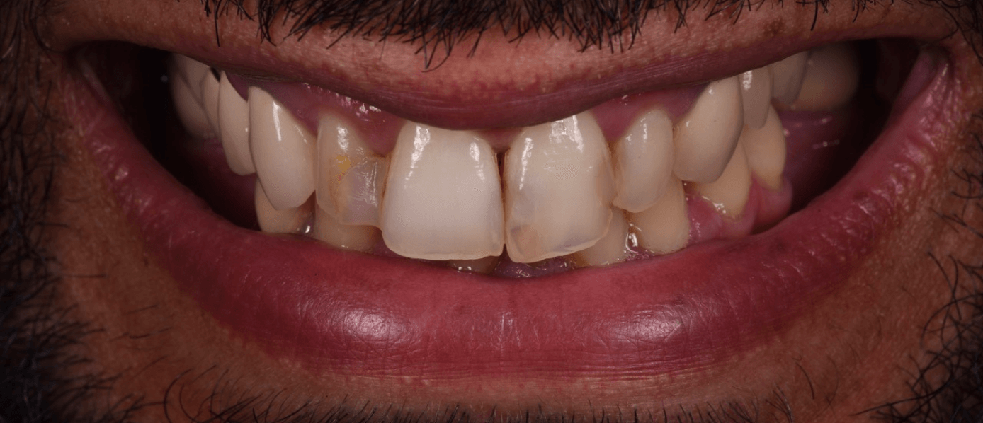 réhabilitation-dentaire-complète