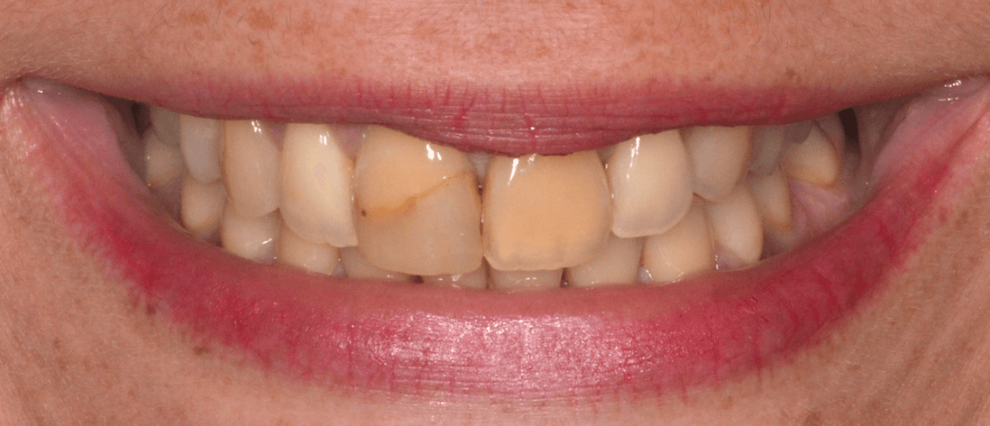 Eclaircissement-Blanchiment-Dentaire