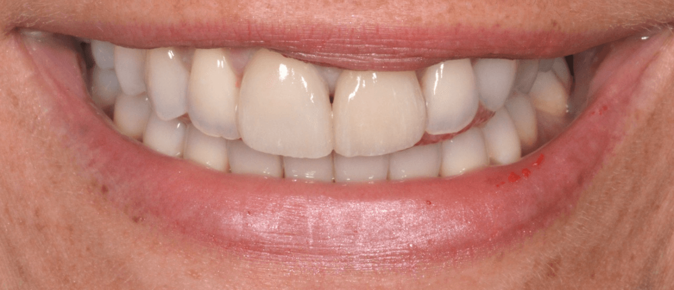 Eclaircissement-Blanchiment-Dentaire