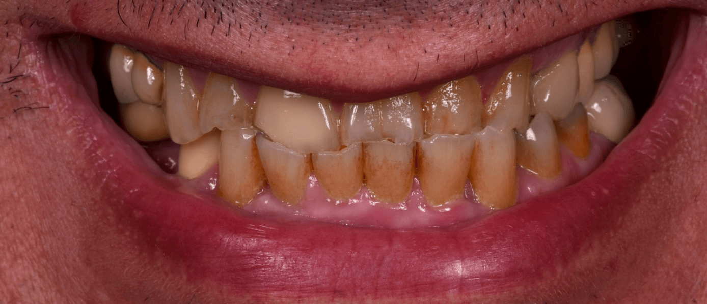 réhabilitation-dentaire-complète